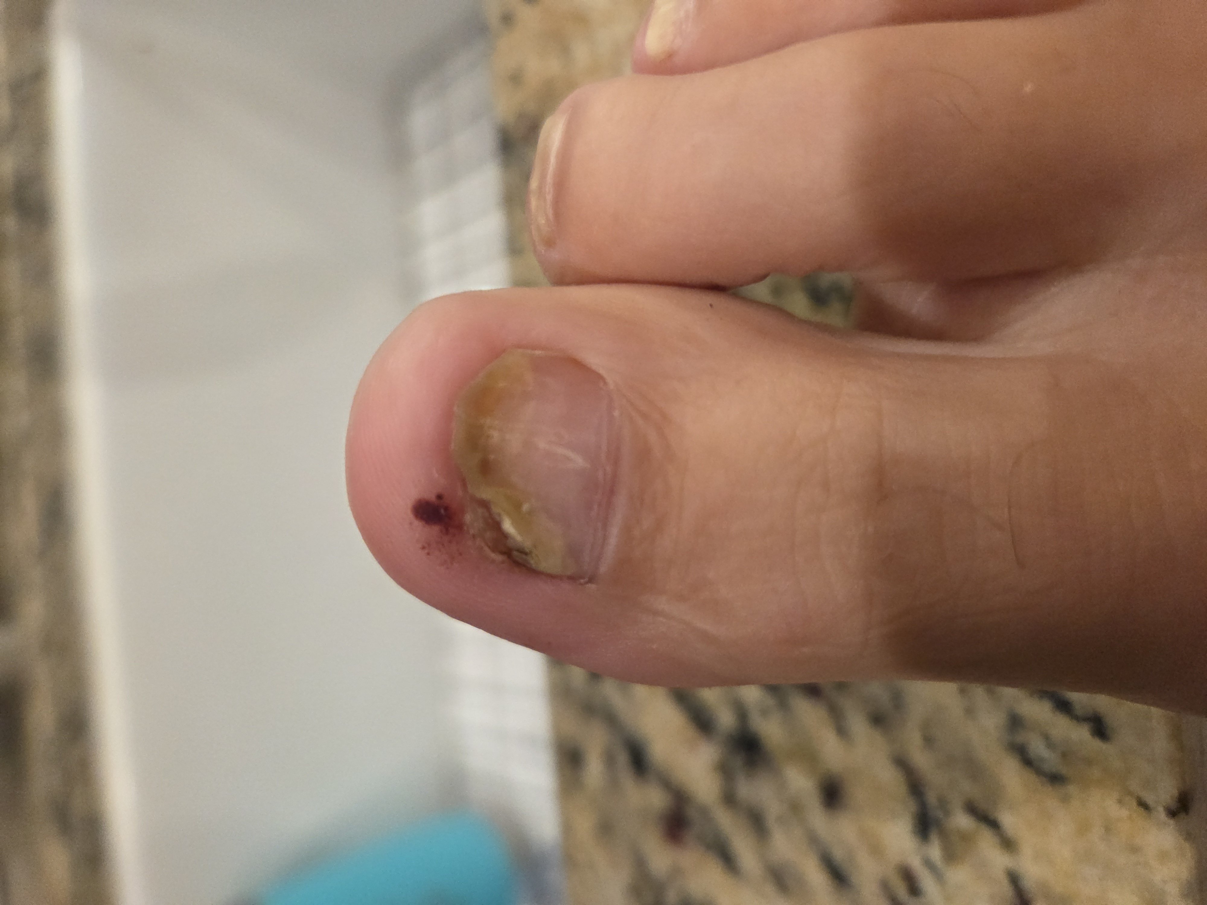 Toe post by bigtoe1