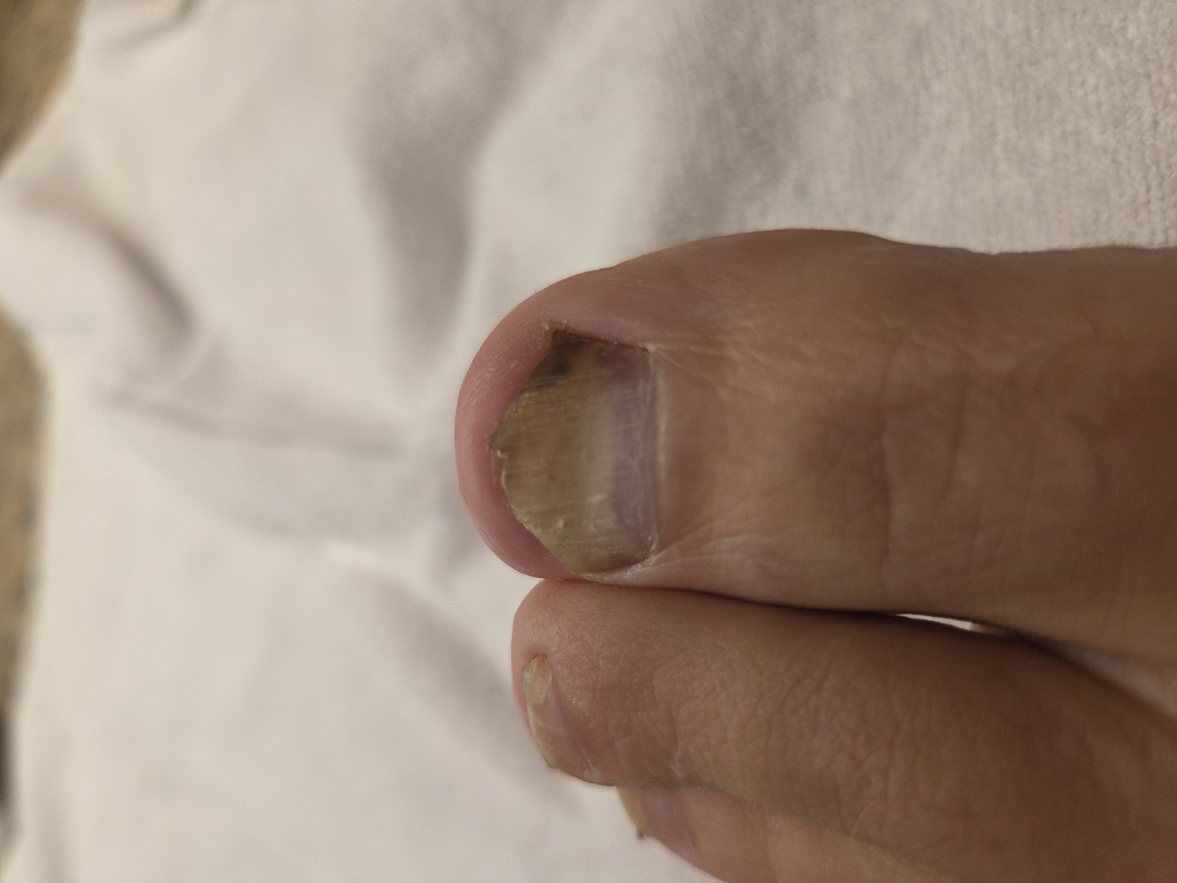 Toe post by bigtoe3